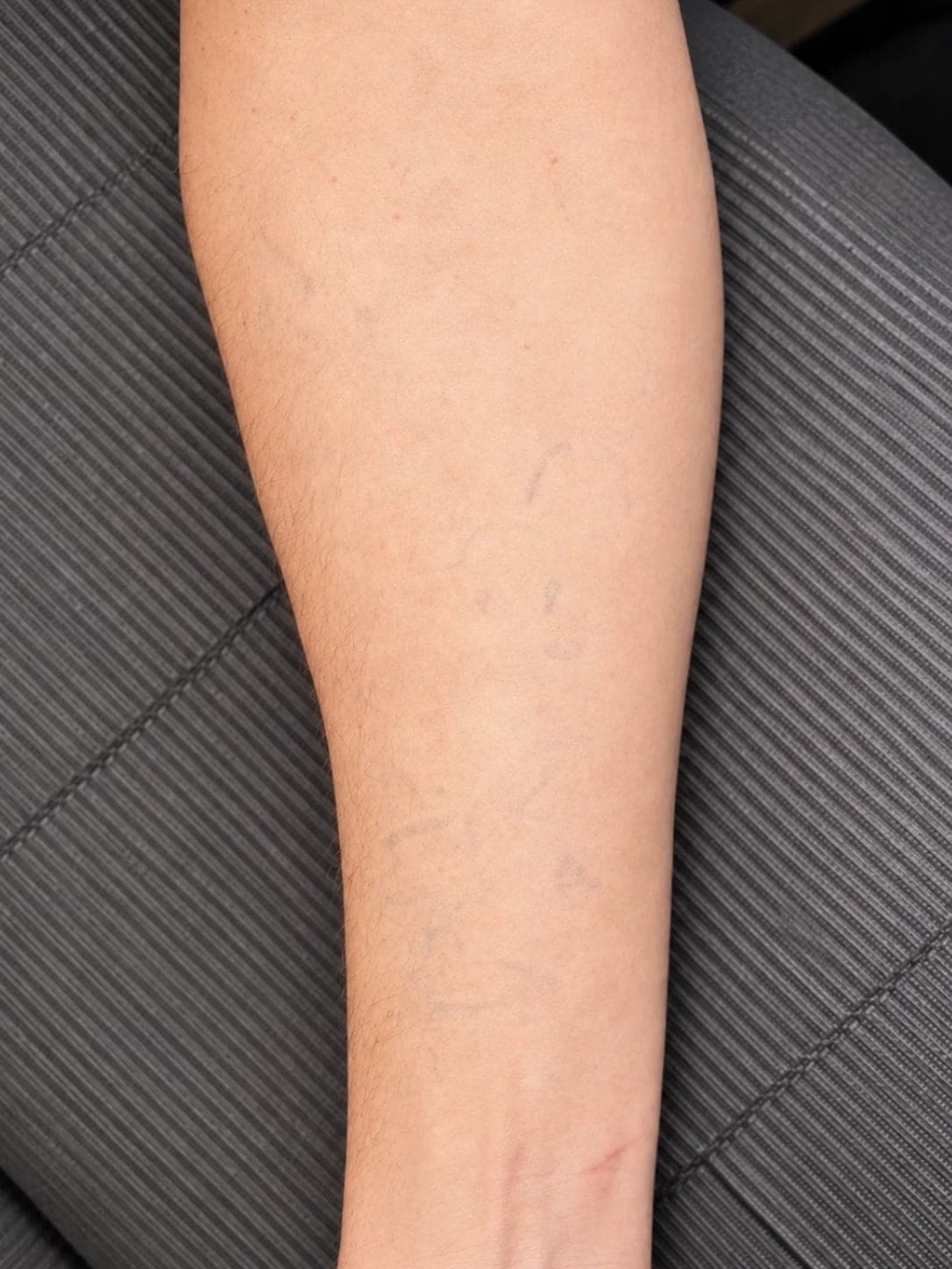 Předloktí po laserovém odstranění tetování